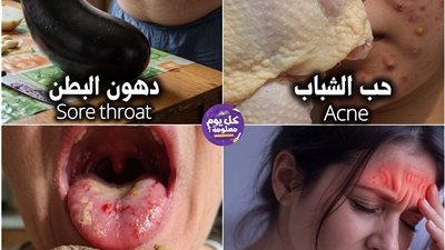 حب الشباب  بسبب أكل جلد الدجاج  دهون البطن الباذنجان يساعدك على التخلص من الدهون
