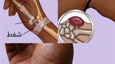 الكيس الزليلي (الور،م العُقدي): ما هو وكيف يتم التعامل معه؟ سأعطـيك التفاصيل مقابل كلـمة “OK” بسيـطة في التعلـيق وشـاهد أول تعليق