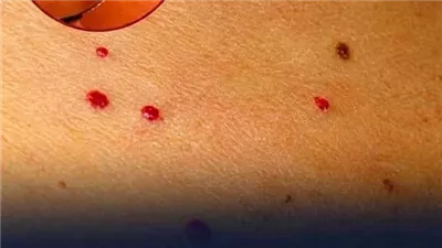 أسباب ظهور نقاط حمـراء على بشرتك.. الطبيب يكشف معناها المحتمل
