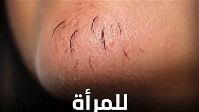 اذا كنتِ امرأة تعاني من شعر الذقن انتبهي أليكِ ما يعتيه هذا