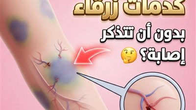 ما سبب ظهور كدمات بدون أن تتذكر إصابة؟
