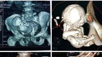 عجوز جزائرية عمرها 73 عامًا حامل في جنين منذ 35 سنة!