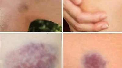 أعراض الجلـطة القلبية قبل حدوثها