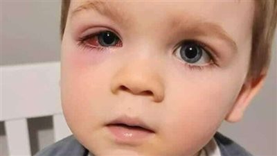 ما هى عوامل الخطر المعززة لفرص الإصابة بالفطر الأسود؟ 