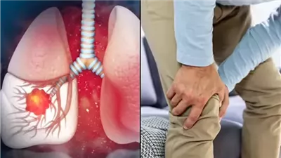 انتبه لساقيك 6 أعراض مبكرة لسړطان الرئة تظهر عليهما