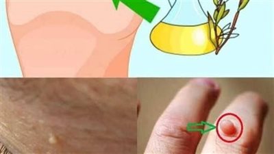 اسرع عـلاج منـزلي طبيعي وفعال للتخلص من الزوائد الجلديه