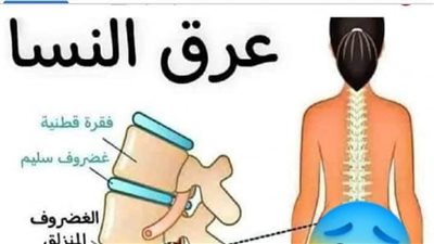 عرق النسا