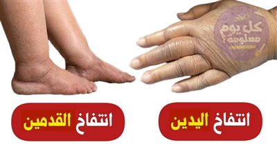 الانتفاخ