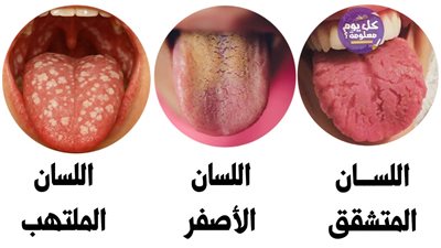 مشاكل اللسان