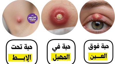 حبة فوق العين