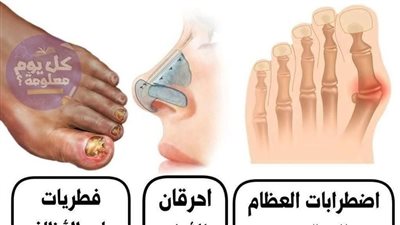 النقرس و فطريات الاظافر 