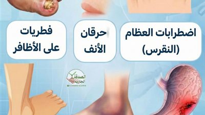 اضطـرابات العظام النقـرس ارتفاع حمـض البـول احتقـان الأنف