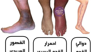 دوالي الساقين