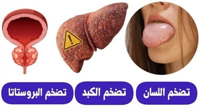 تضخم اللسان بسبب الحساسية الأدوية