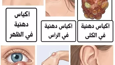أكياس دهنية في الرأس…عرض المزيد