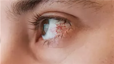 علاج جفاف العين بدون أدوية 7 طرق تساعدك