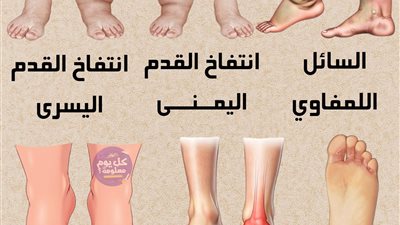 السائل اللمفاوي : بسبب أمراض القلب - السمنة ✅️ انتفاخ القدم اليمنى : بسبب التواء الكاحل - السكري