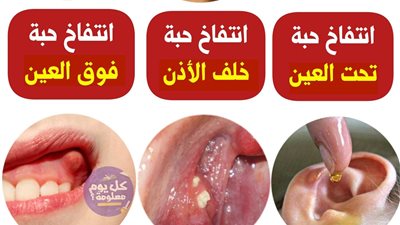 انتفاخ حبة تحت العين