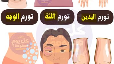 تورم اليدين تورم اللثة تورم القدمين تورم الوجه تورم العين انتفاخ البطن