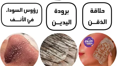  حلاقة الذقن للنـساء : بسبب عدم توازن في هرمونات الذكورة  برودة اليدين : بسبب