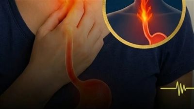 اسباب ارتجاع المريء والعلاج الانسب